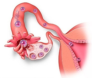 endometriozis-komplikasyonlari