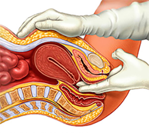 endometriozis-tanisi