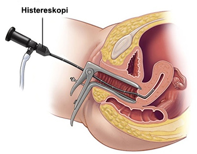 infertilite-histeroskopi