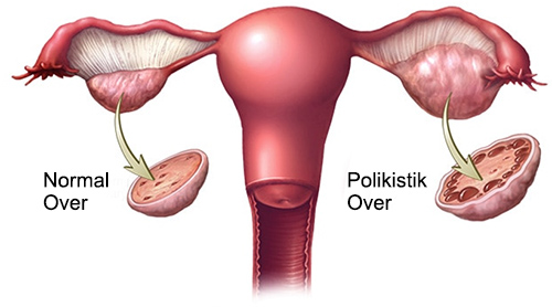 poliskistik-over